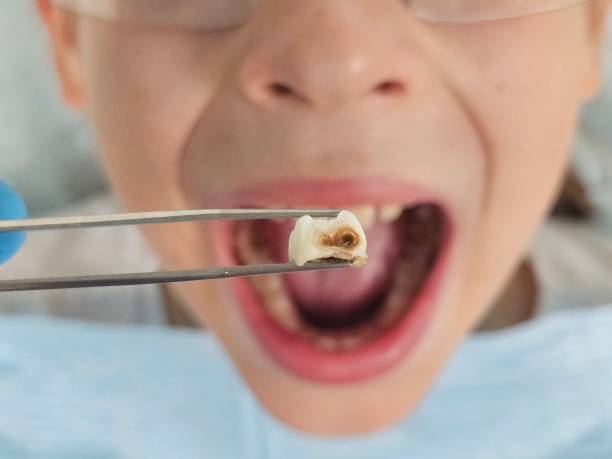 Best Emergency Wisdom Tooth Extraction in Bethel Manor, VA